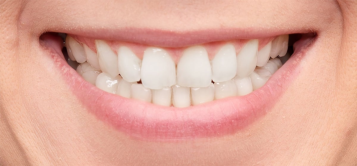 teeth-whitening-front-royal-va-after