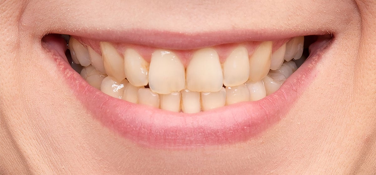 teeth-whitening-front-royal-va-before